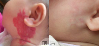 广州哪家医院可以治疗鲜红斑痣