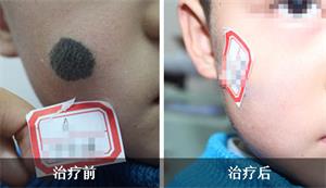 在广州孩子多大可以治疗黑毛痣