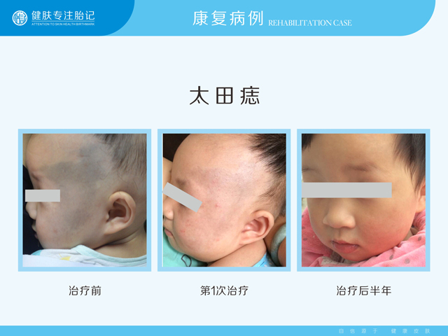 广州哪家医院能看婴儿青胎记