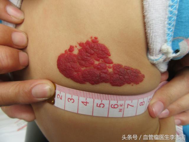 广东省哪家医院能看血管瘤