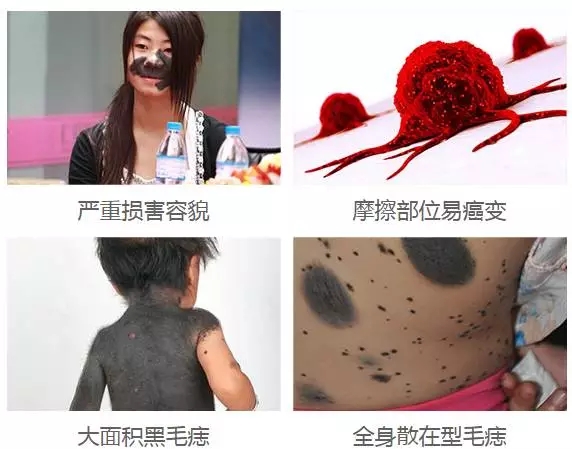 广州黑毛痣治疗需要多少钱