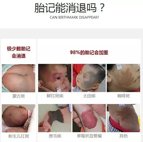 广州去胎记医院哪家有名?